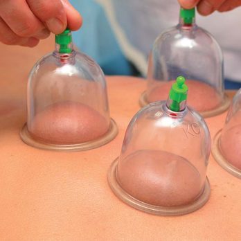 Cupping